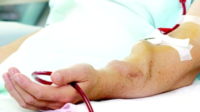 patient's arm that is actively going their hemodialysis with a flow-based trasonic heomdialysis machine