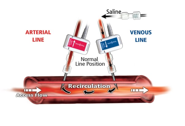 Vascular Access Recirculation