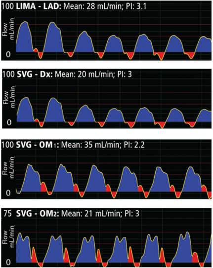 Analysis of a Bypass Graft Waveform: 5 Things to Look For