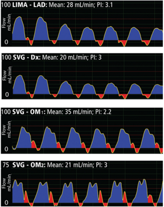 analysis-of-a-flow-waveform