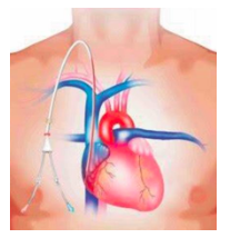 Caring for Your Central Venous Catheter