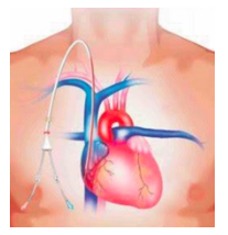 central-venous-catheter