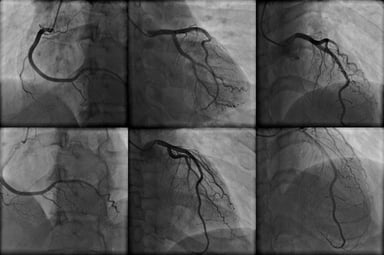 pulsatility-index