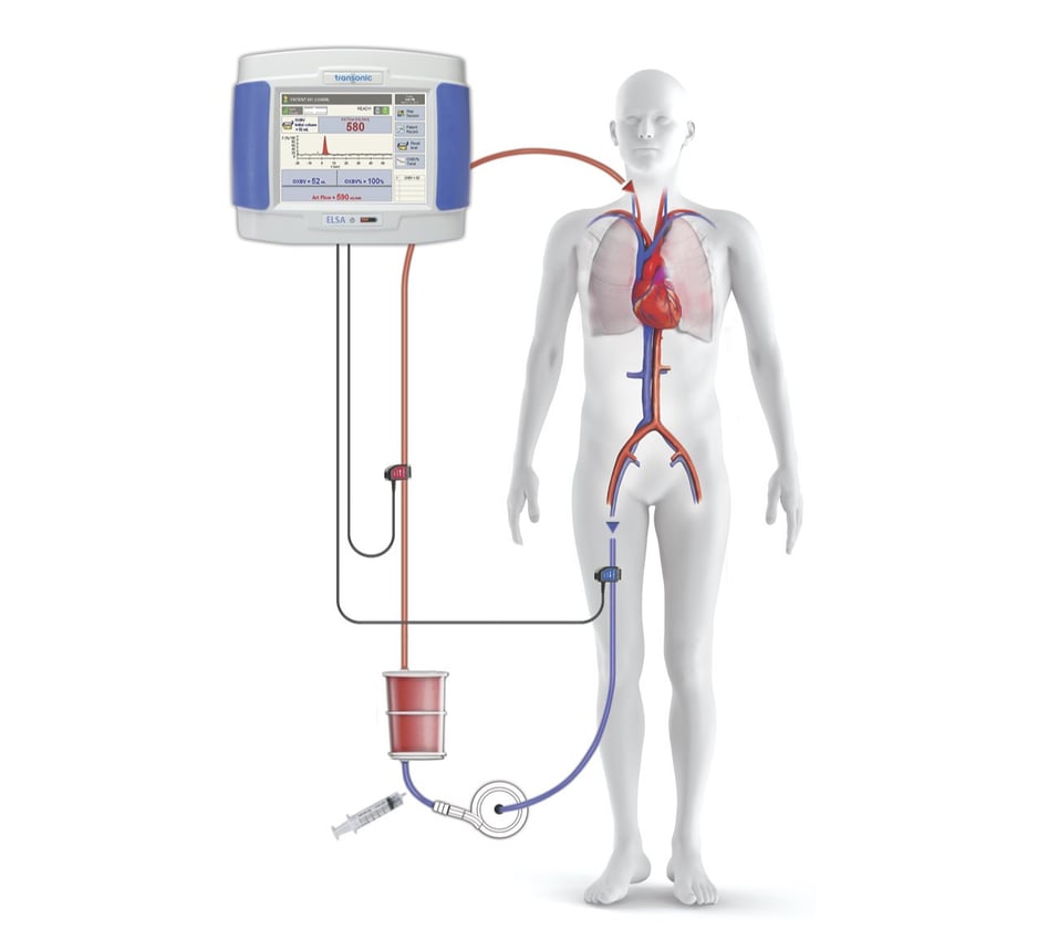 What You Need to Know About ECMO for Adults