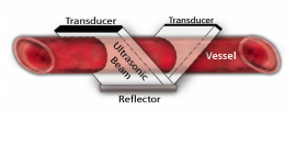 transit time ultrasound, Picture