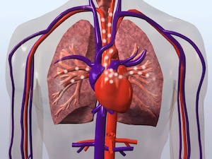 ventricular assist device 